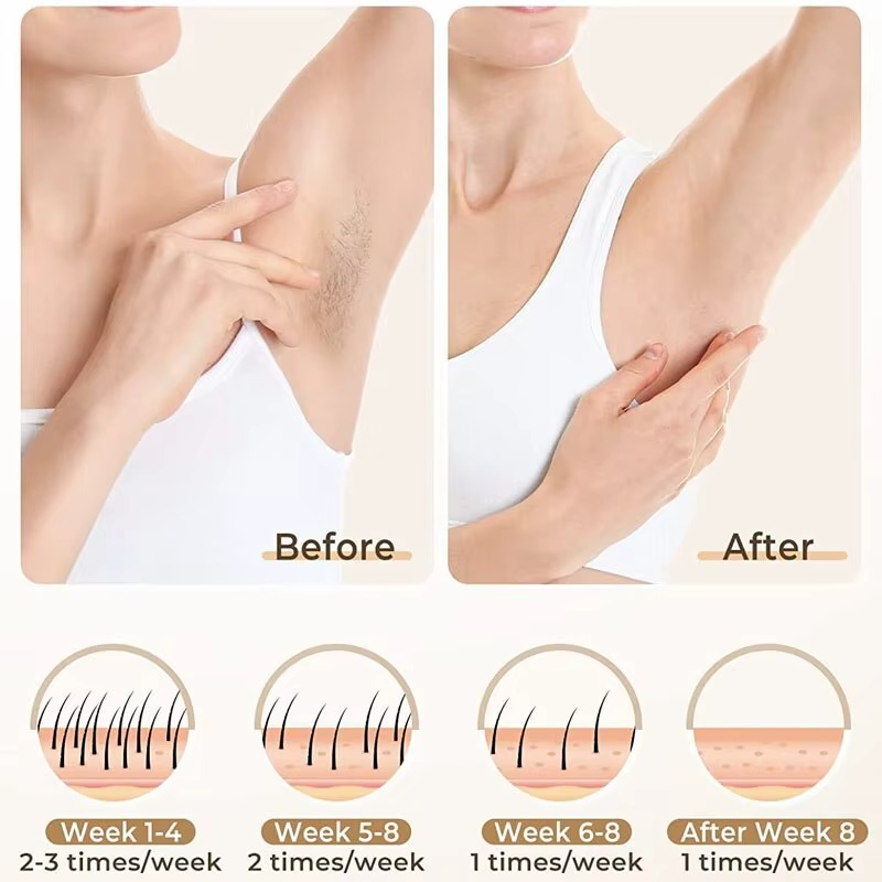 IPL Hair Removal Device